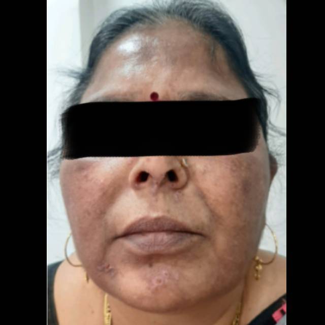 Dermatologist for Chemical Peel in Kothrud