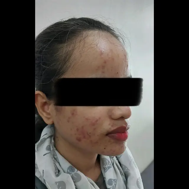 Lip Filler Treatment in Kothrud pune