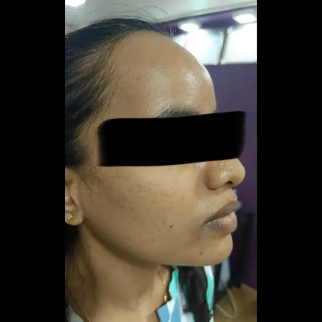 Lip Filler Treatment in Kothrud