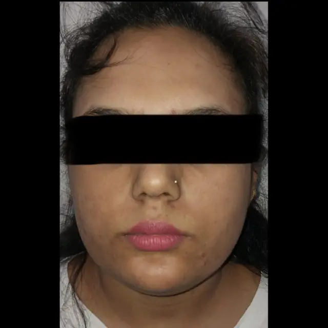 Lip Care Treatment in Kothrud