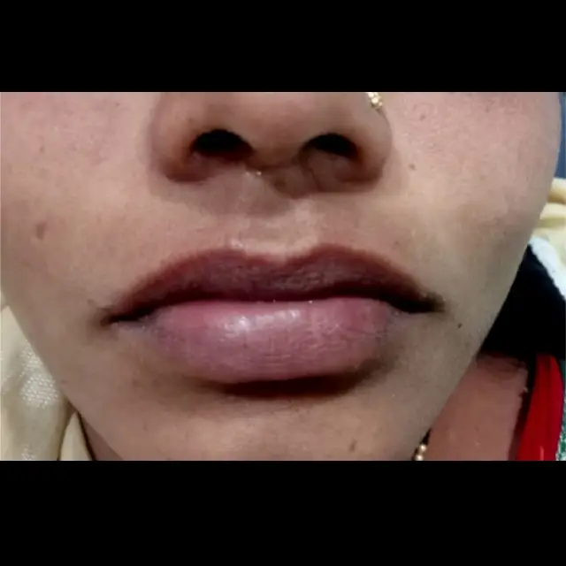 Lip Lightening Treatment in Kothrud pune