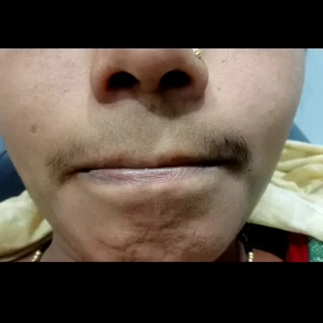 Lip Lightening Treatment in Kothrud