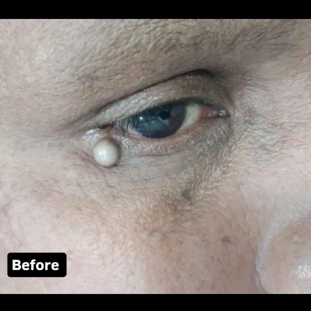 Mole Removal treatment in kothrud