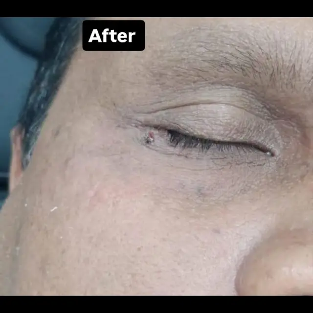 Safe Mole Removal in Kothrud