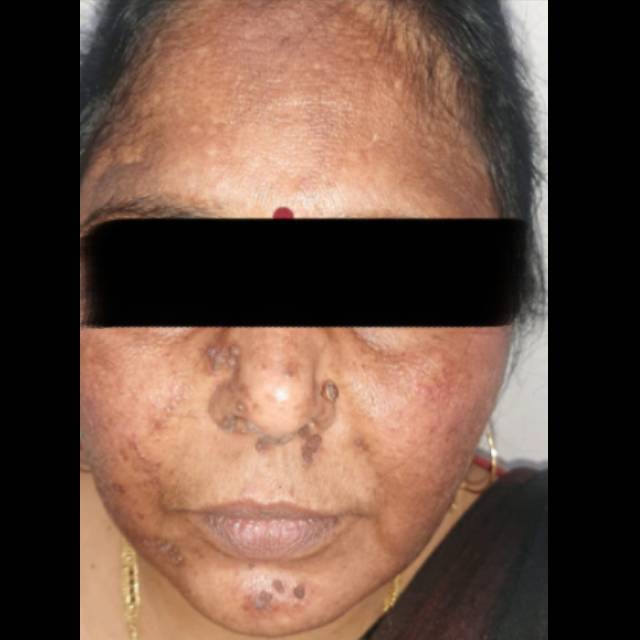 Chemical Peel for Skin Brightening in Kothrud