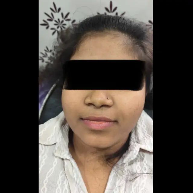 Dark Lip Treatment in Kothrud
