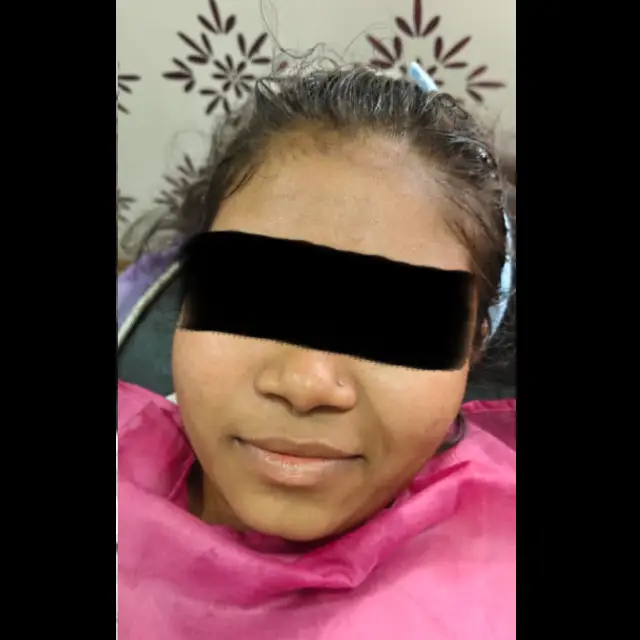 Pigmentation in Kothrud