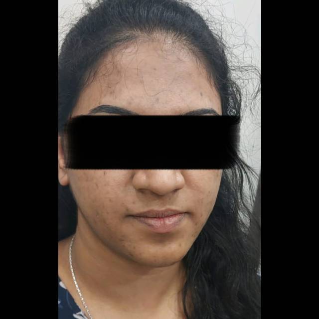 Medical Chemical Peel in Kothrud
