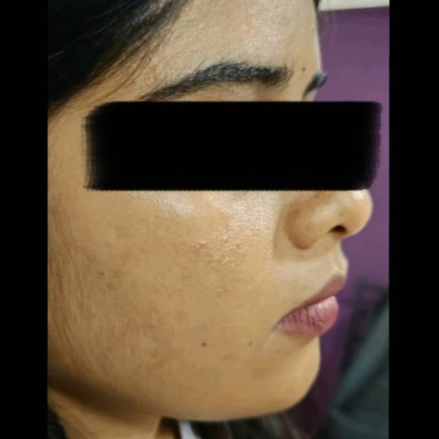Chemical Peel for Acne Scars in Kothrud