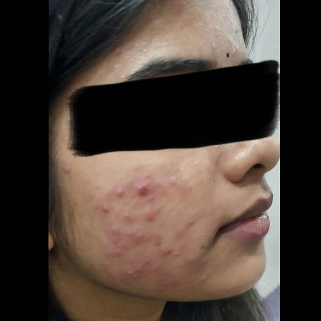 Chemical Peel for Pigmentation in Kothrud