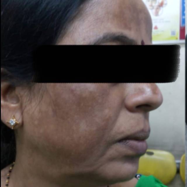 Pigmentation Treatment in Kothrud pune