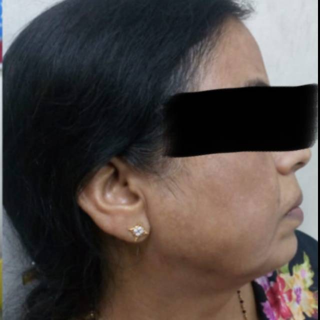 Pigmentation Treatment in Kothrud