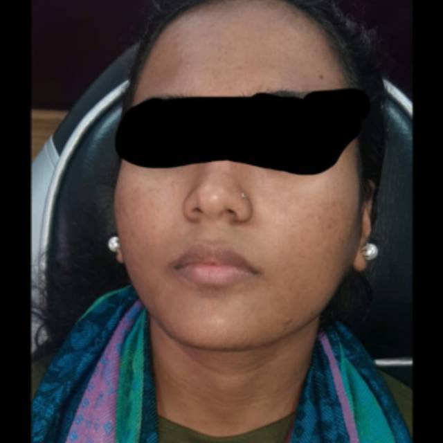 Open Pores Treatment in Kothrud