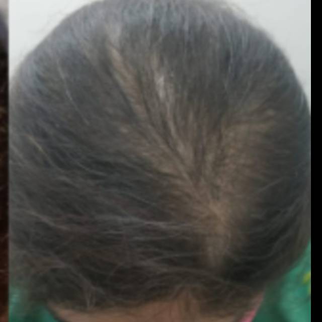 Hair Fall Treatment in Kothrud