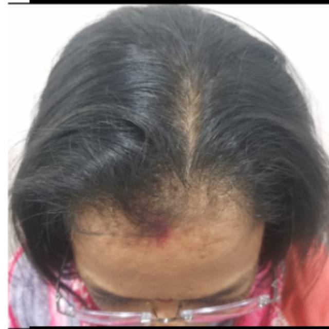 Hair Loss Treatment in Kothrud