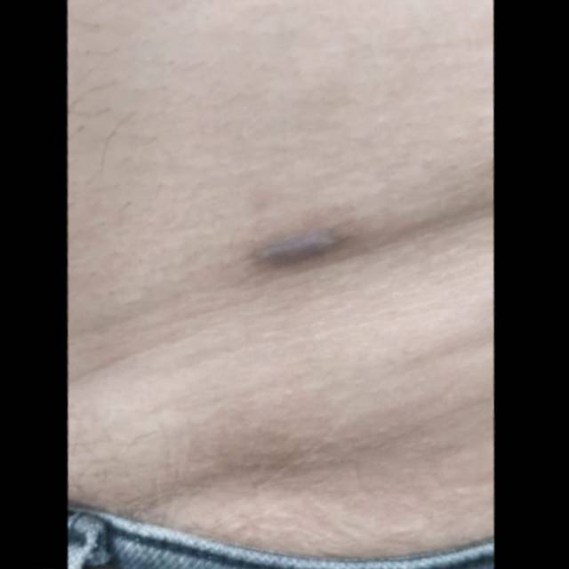 Best Skin Doctor for Mole Removal in Kothrud