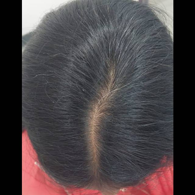 Hair Treatment Clinic near Kothrud Pune