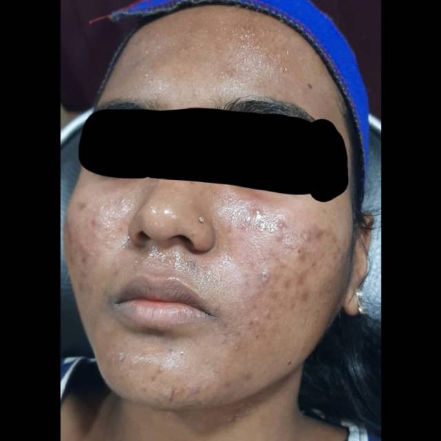 Tan Removal Treatment in Kothrud