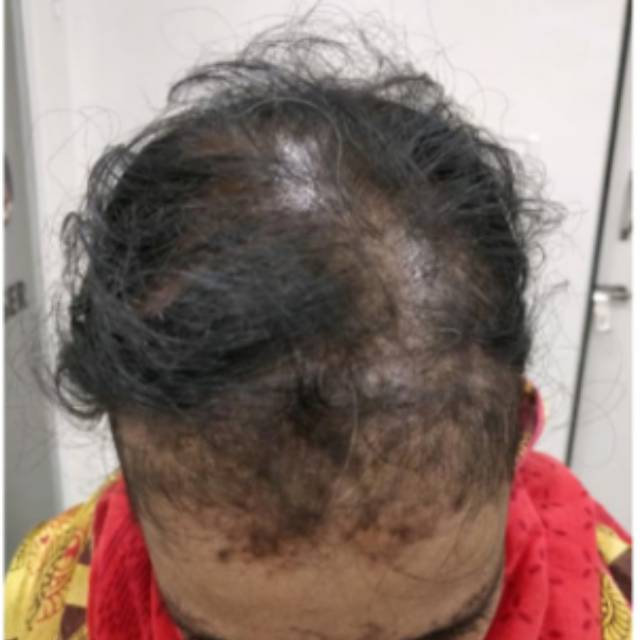 Hair Clinic in Kothrud Pune