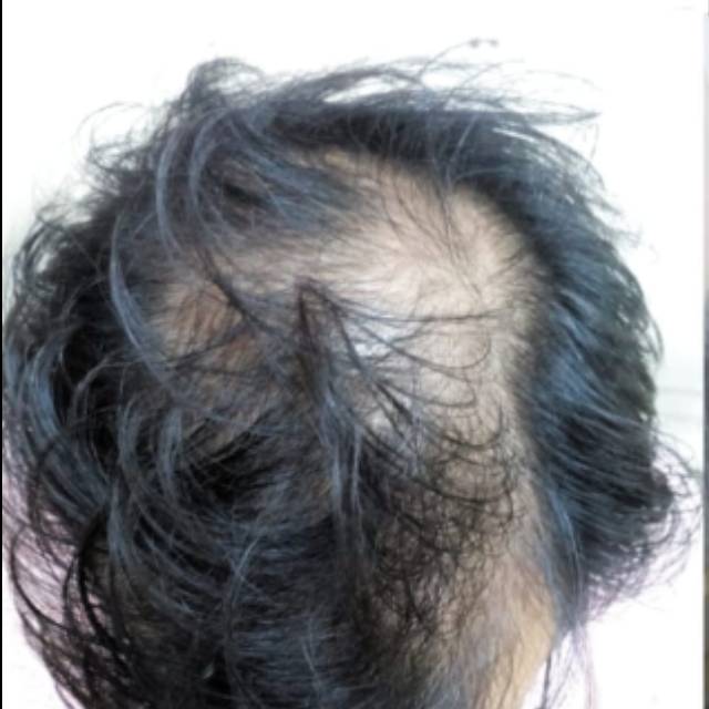 Best Hair Treatment in Kothrud