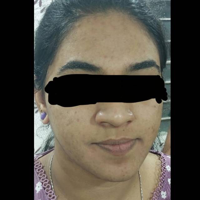 Dark Circle Treatment in Kothrud