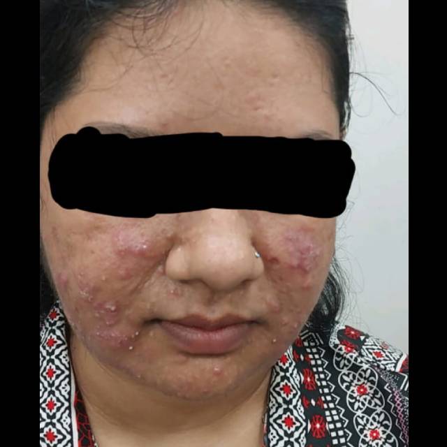 Laser Treatment for Acne Scars in Kothrud
